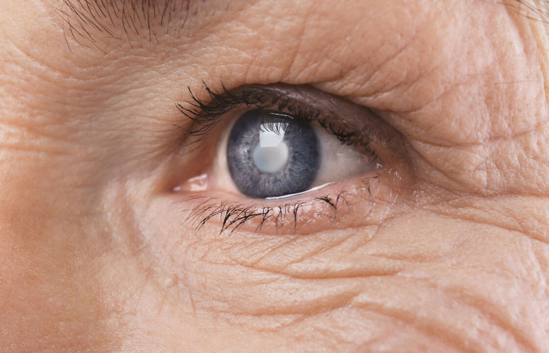 Cataract-surgery-How-should-you-prepare-before-undergoing-it