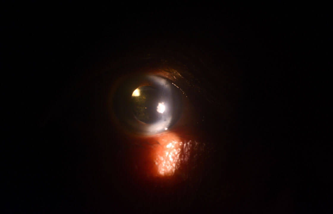 Eyes Post Cataract Surgery