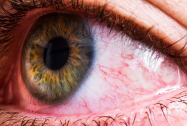 Comprehensive Guide To Eye Allergies
